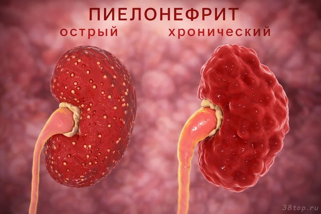 Острый и хронический пиелонефрит