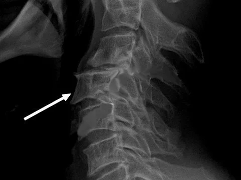 Антелистез шейного отдела позвоночника на рентгеновском снимке