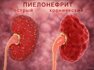 Пиелонефрит: симптомы, лечение