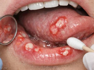 Стоматит – воспаление слизистых оболочек ротовой полости